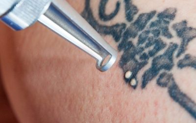 Un Tatuaggio è Per Sempre?