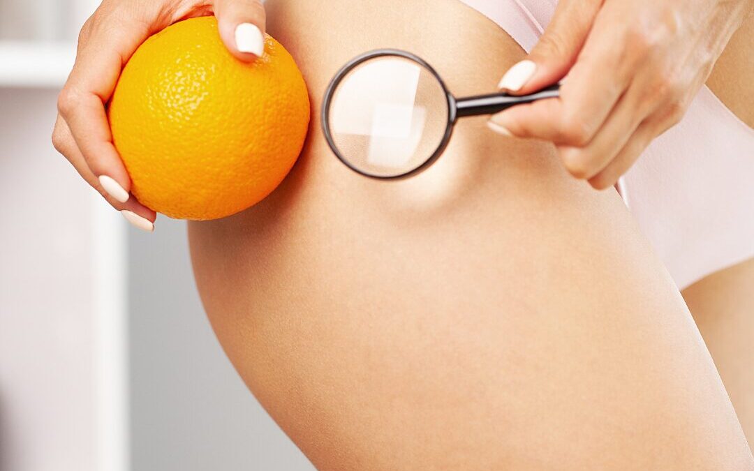 Conosci la differenza tra Cellulite e Adiposità Localizzata? Leggi Qui, ti spiego la differenza!